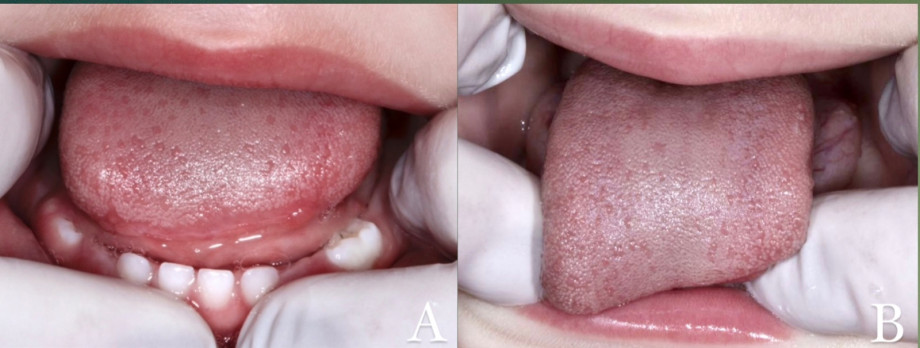 TCC da Odontologia aborda tratamento de lesão em língua de paciente de dez meses